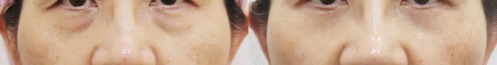 눈밑지방재배치 시술 전후 사진 16 · 보니따의원