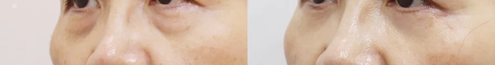 눈밑지방재배치 시술 전후 사진 17 · 보니따의원