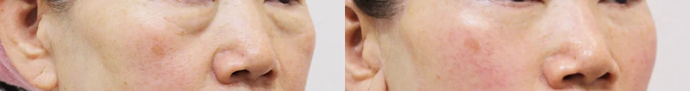 눈밑지방재배치 시술 전후 사진 19 · 보니따의원