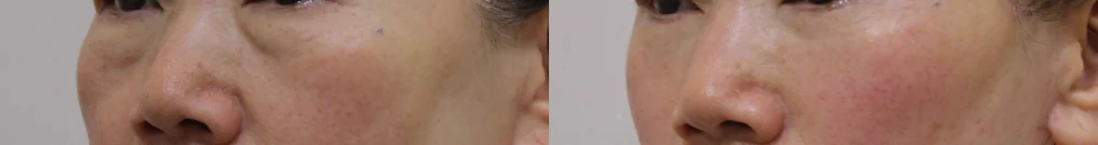 눈밑지방재배치 시술 전후 사진 20 · 보니따의원