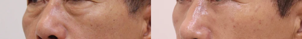 눈밑지방재배치 시술 전후 사진 23 · 보니따의원