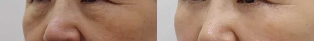 눈밑지방재배치 시술 전후 사진 26 · 보니따의원