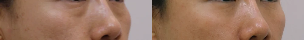 눈밑지방재배치 시술 전후 사진 29 · 보니따의원