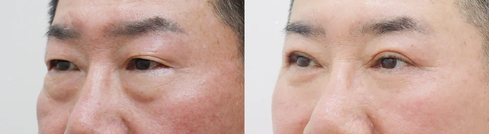 중년 눈 성형 시술 전후 사진 5 · 보니따의원