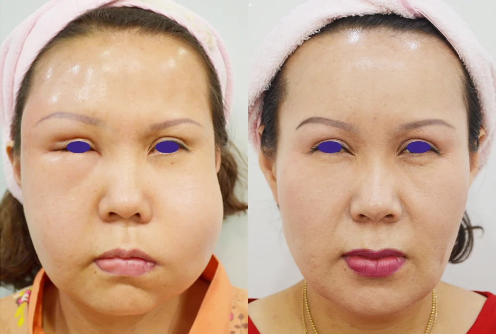입·입술 부작용 재건 시술 전후 사진 1 · 보니따의원