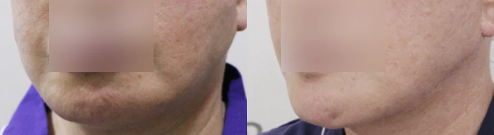 흉터 제거 후 멀티 리프팅 시술 전후 사진 5 · 보니따의원