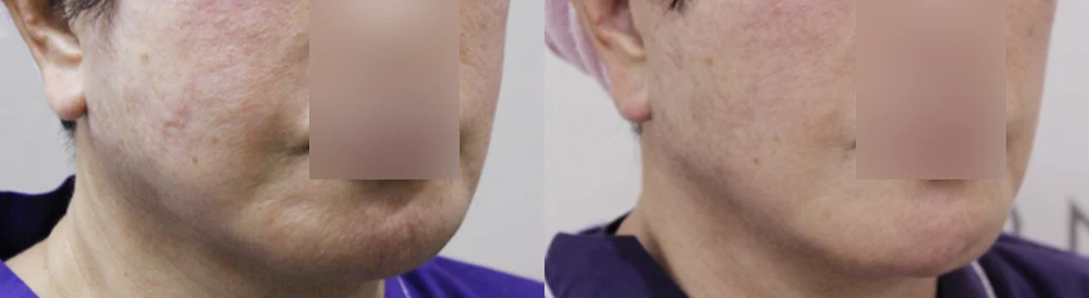 흉터 제거 후 멀티 리프팅 시술 전후 사진 6 · 보니따의원