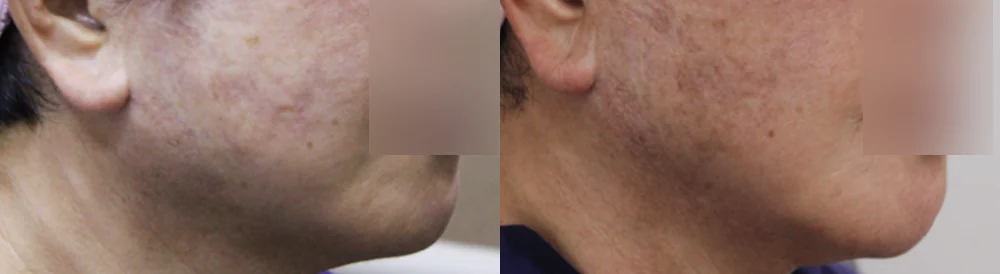흉터 제거 후 멀티 리프팅 시술 전후 사진 7 · 보니따의원