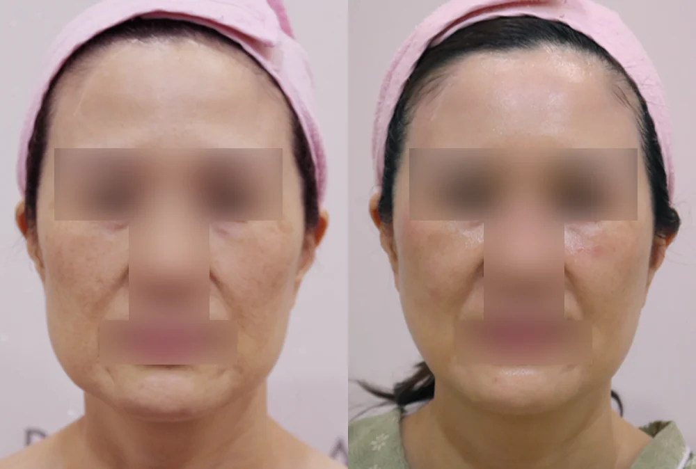 멀티리프팅 시술 전후 사진 1 · 보니따의원