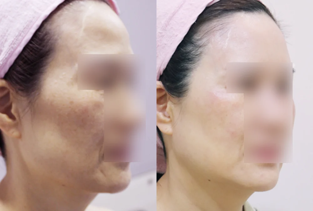 멀티리프팅 시술 전후 사진 3 · 보니따의원