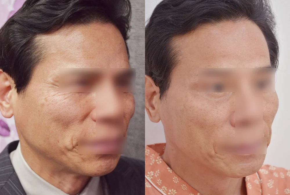 멀티리프팅 시술 전후 사진 2 · 보니따의원