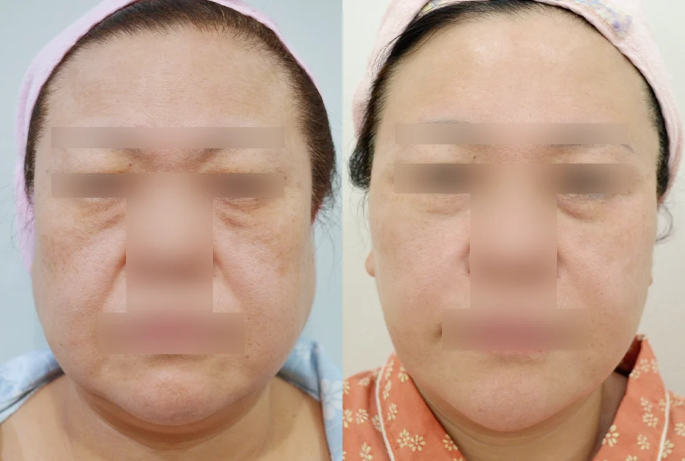 멀티리프팅 시술 전후 사진 5 · 보니따의원