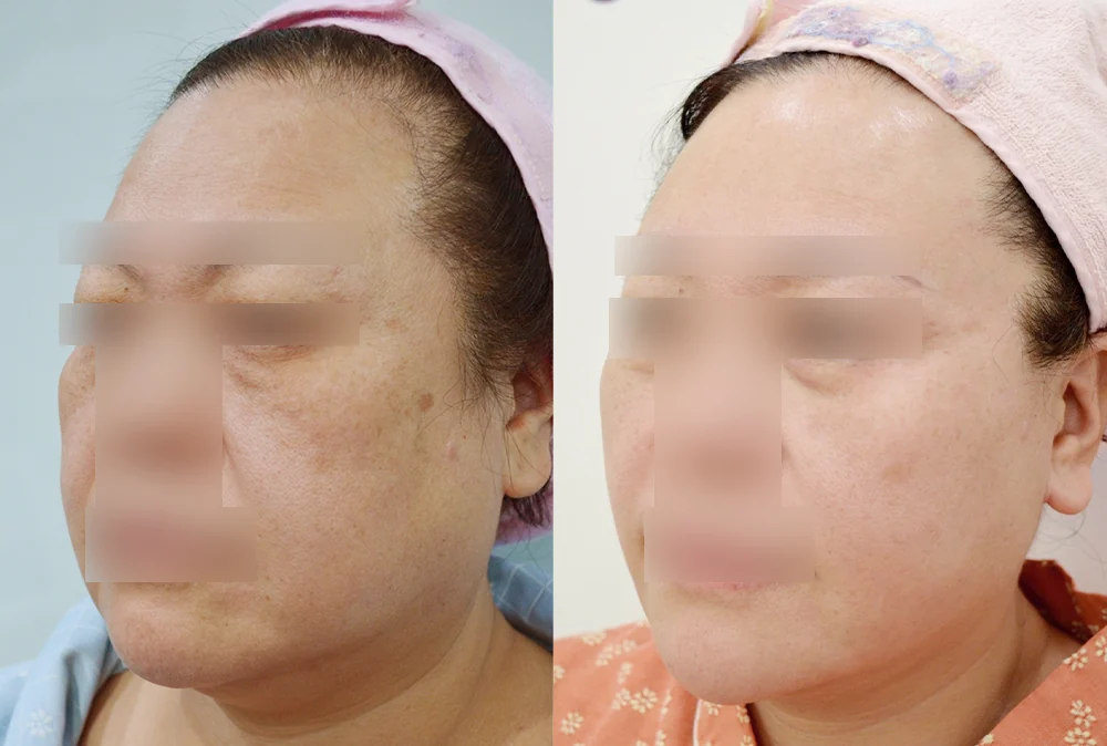 멀티리프팅 시술 전후 사진 6 · 보니따의원