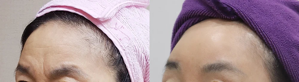 멀티리프팅 시술 전후 사진 28 · 보니따의원