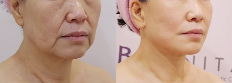 멀티리프팅 시술 전후 사진 20 · 보니따의원