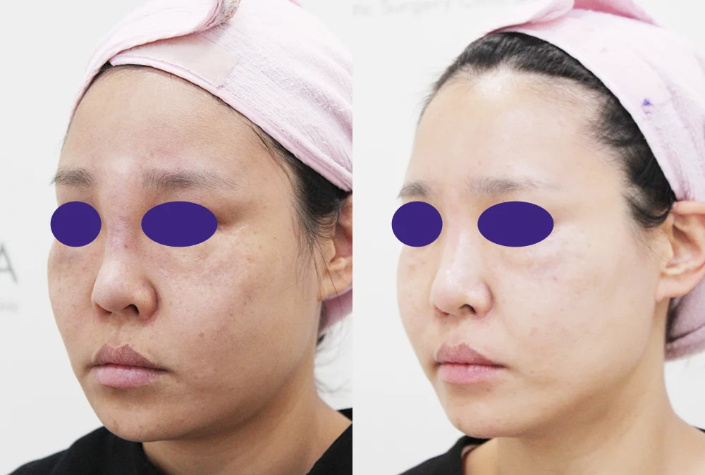 鼻先の再手術 術前術後の写真 3 · ボニータクリニック