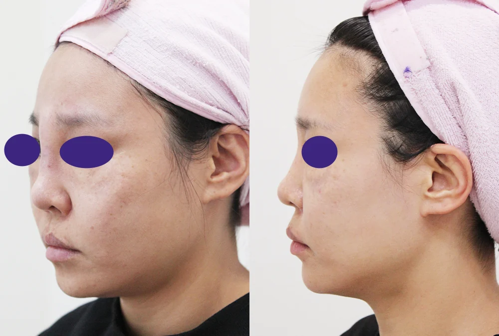 鼻先の再手術 術前術後の写真 2 · ボニータクリニック
