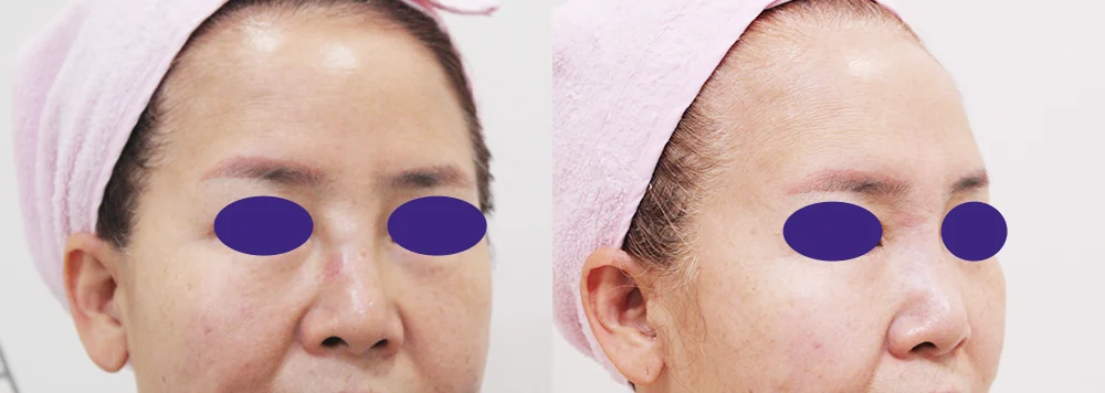 鼻先の再手術 術前術後の写真 8 · ボニータクリニック