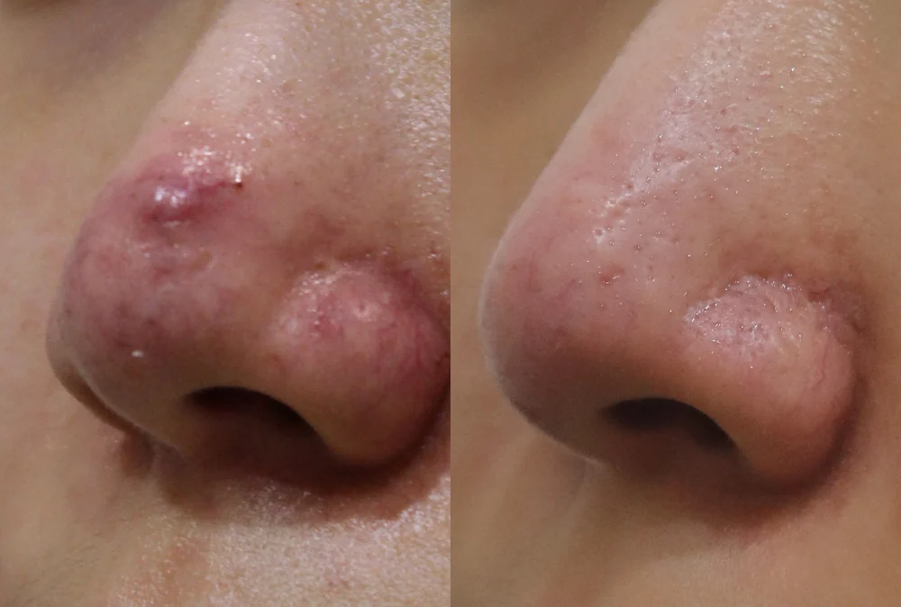 Nose Scars before & after photo 1 · Bonita Clinic Seoul