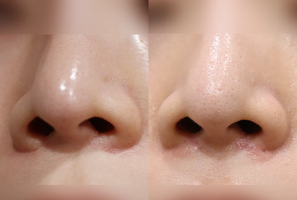 Nose Scars before & after photo 3 · Bonita Clinic Seoul