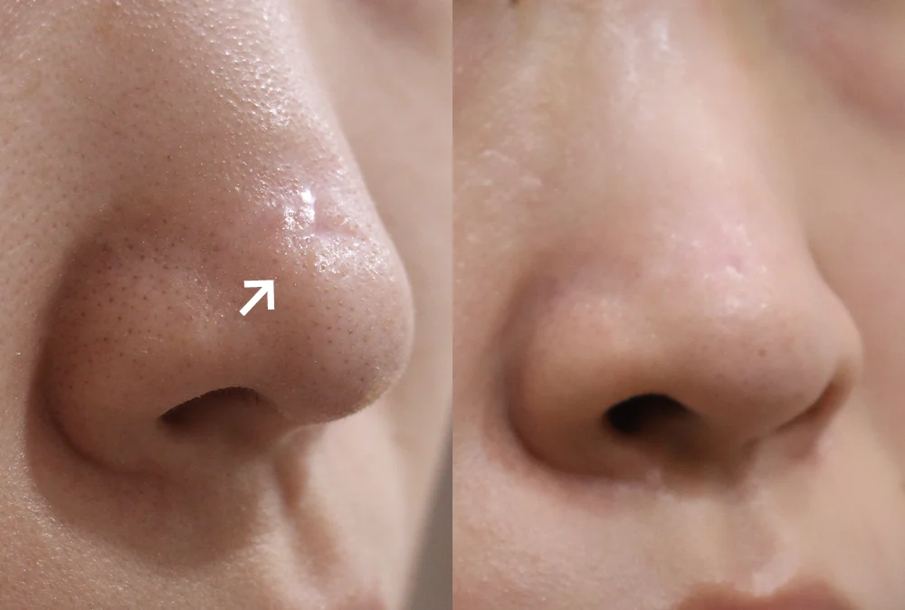 Nose Scars before & after photo 4 · Bonita Clinic Seoul