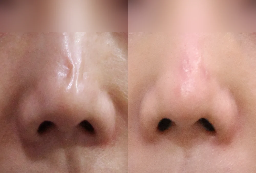Nose Scars before & after photo 5 · Bonita Clinic Seoul