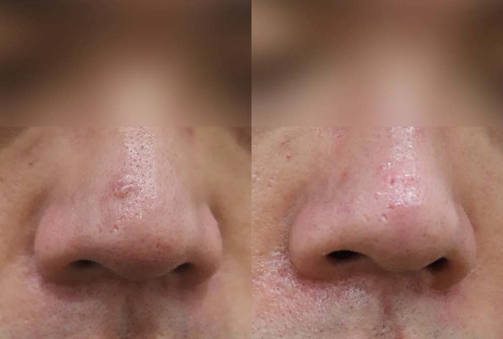 Nose Scars before & after photo 6 · Bonita Clinic Seoul