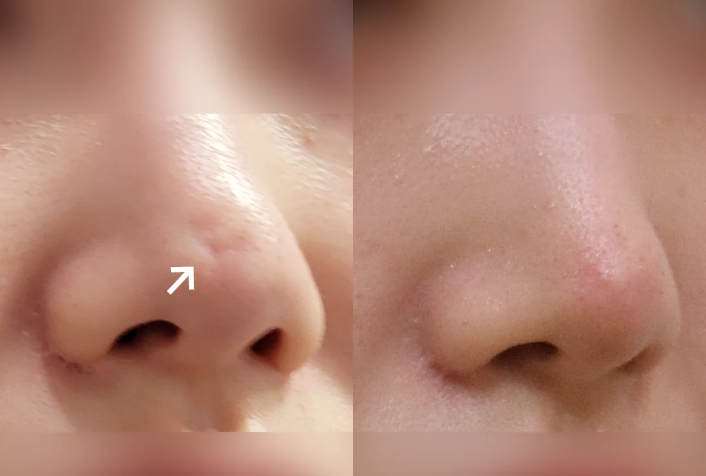 Nose Scars before & after photo 7 · Bonita Clinic Seoul