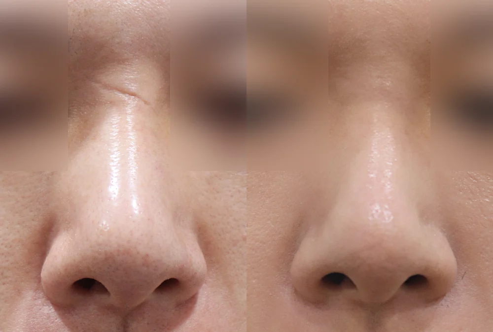 Nose Scars before & after photo 8 · Bonita Clinic Seoul