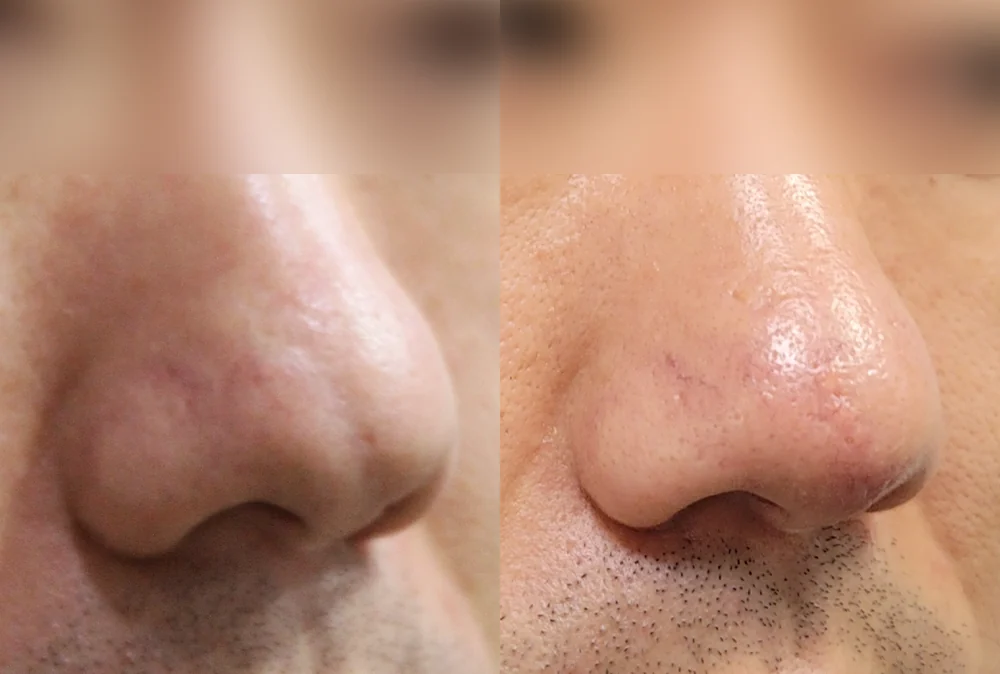 Nose Scars before & after photo 9 · Bonita Clinic Seoul