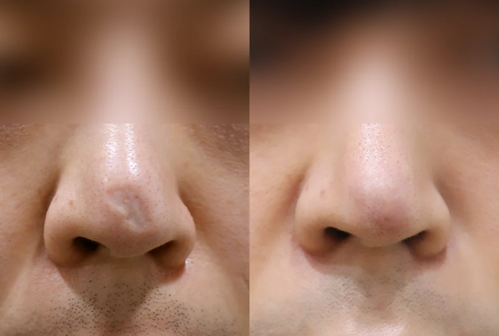 Nose Scars before & after photo 10 · Bonita Clinic Seoul