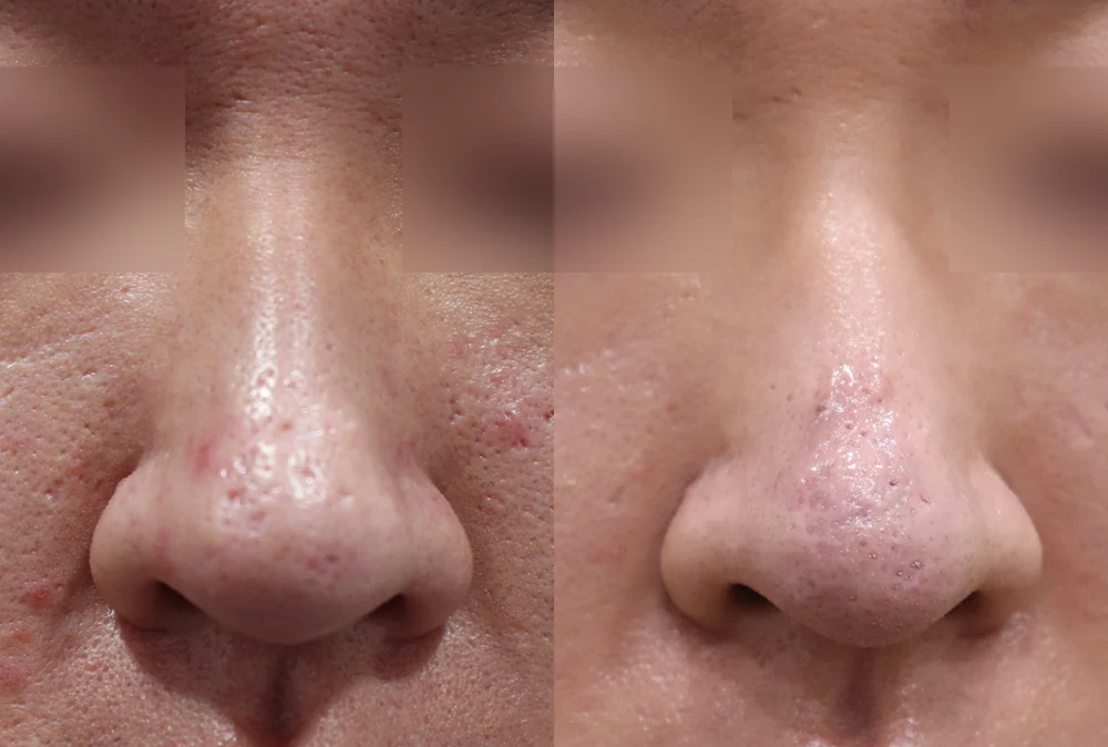 Nose Scars before & after photo 11 · Bonita Clinic Seoul
