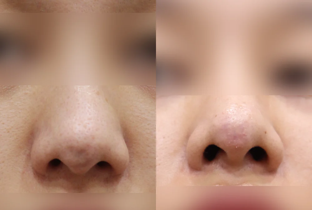 Nose Scars before & after photo 12 · Bonita Clinic Seoul