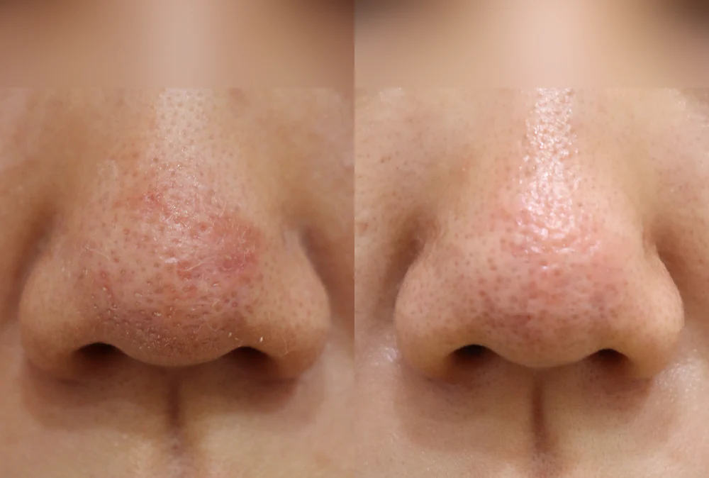 Nose Scars before & after photo 13 · Bonita Clinic Seoul