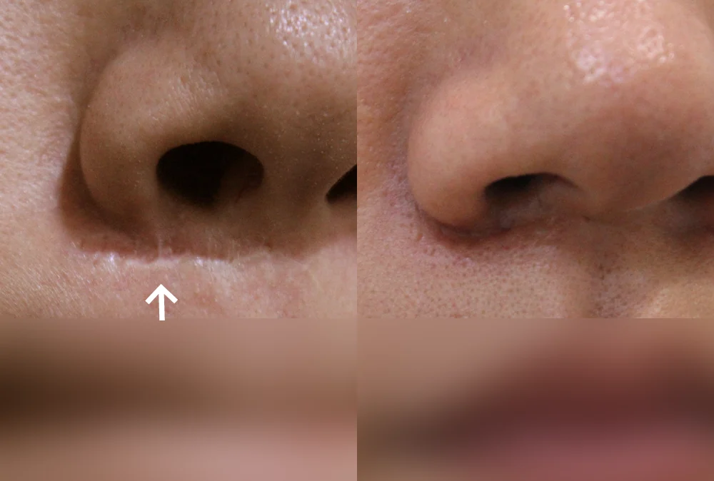 Nose Scars before & after photo 14 · Bonita Clinic Seoul