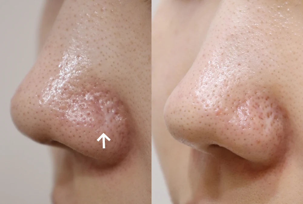 Nose Scars before & after photo 15 · Bonita Clinic Seoul