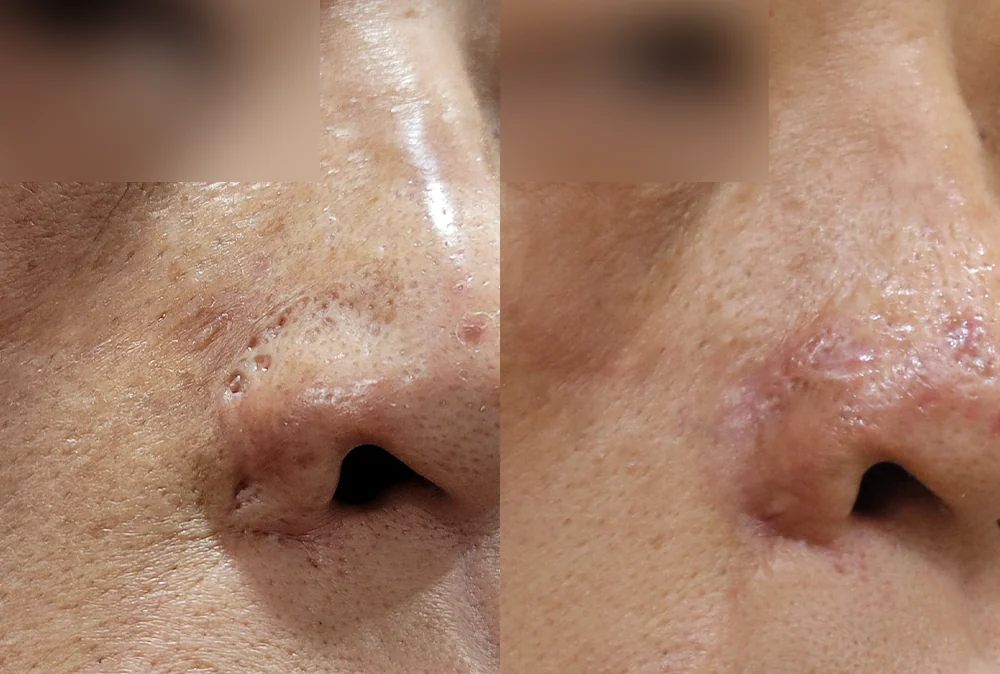 Nose Scars before & after photo 16 · Bonita Clinic Seoul