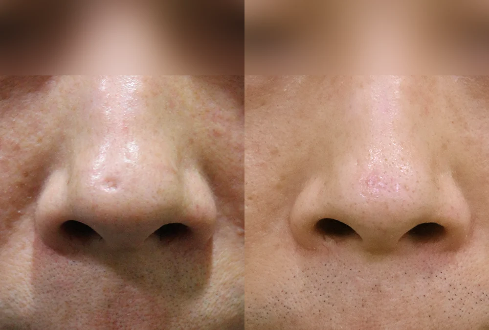 Nose Scars before & after photo 17 · Bonita Clinic Seoul