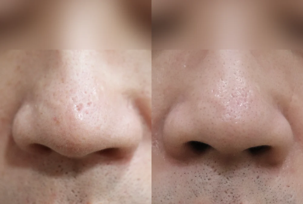 Nose Scars before & after photo 18 · Bonita Clinic Seoul