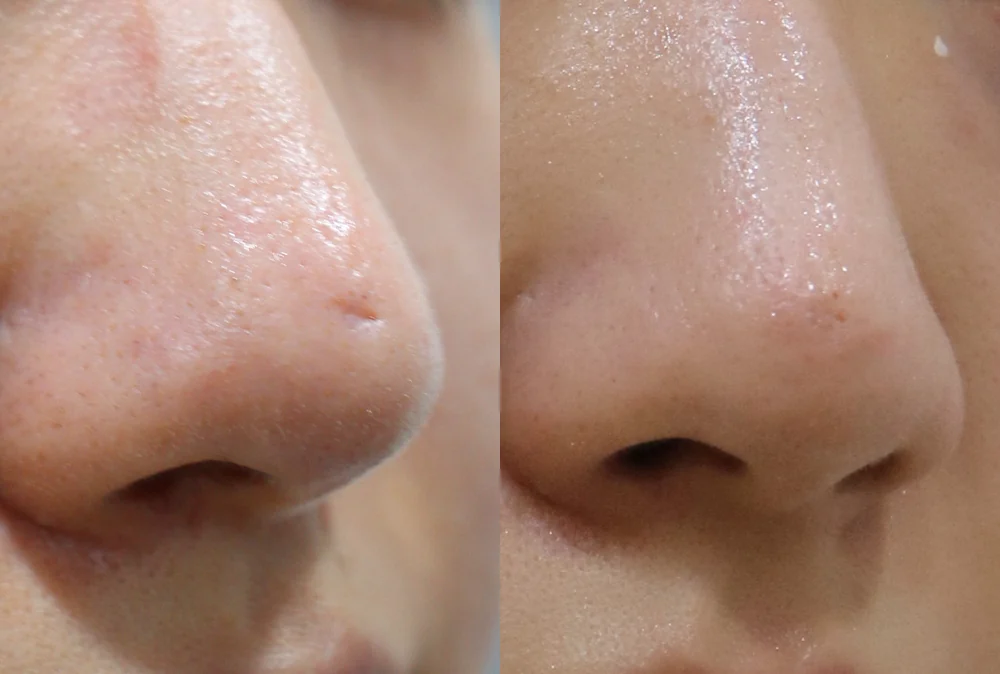 Nose Scars before & after photo 19 · Bonita Clinic Seoul