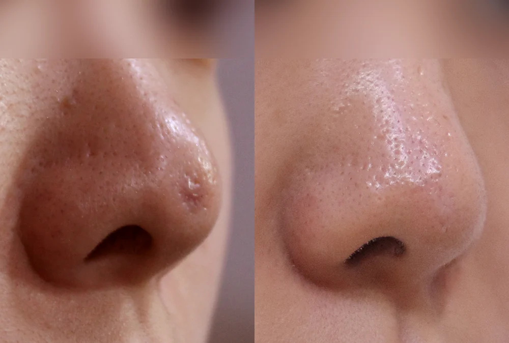 Nose Scars before & after photo 20 · Bonita Clinic Seoul