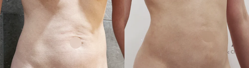 Body Contouring Center before & after photo 16 · Bonita Clinic Seoul