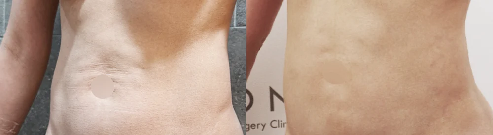 Body Contouring Center before & after photo 18 · Bonita Clinic Seoul