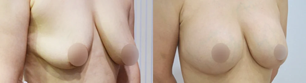 세이프 가슴성형 시술 전후 사진 13 · 보니따의원