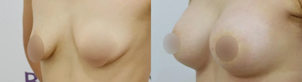 세이프 가슴성형 시술 전후 사진 16 · 보니따의원
