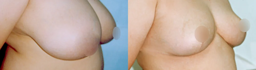 세이프 가슴성형 시술 전후 사진 21 · 보니따의원