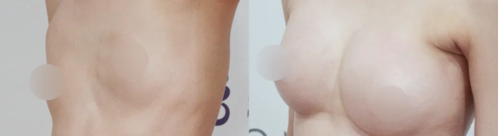 세이프 가슴성형 시술 전후 사진 30 · 보니따의원