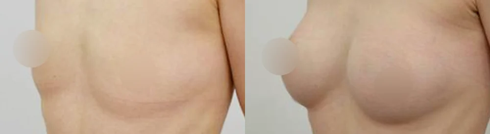 세이프 가슴성형 시술 전후 사진 31 · 보니따의원