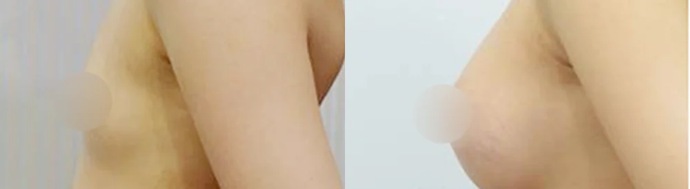 세이프 가슴성형 시술 전후 사진 34 · 보니따의원