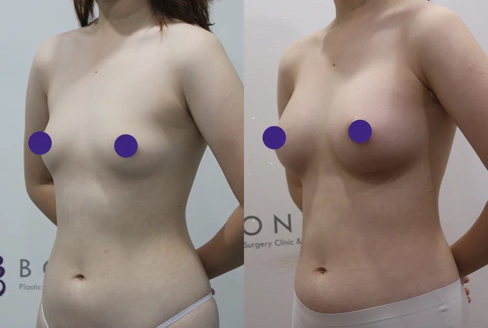 세이프 가슴성형 시술 전후 사진 1 · 보니따의원